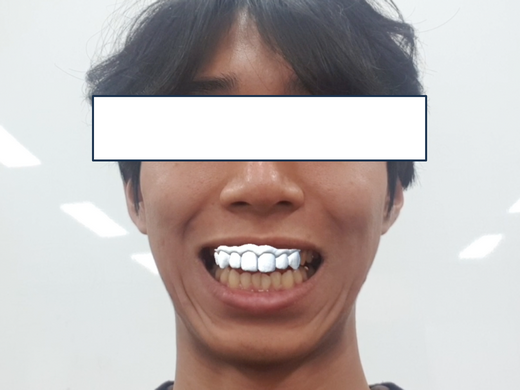DentureAR